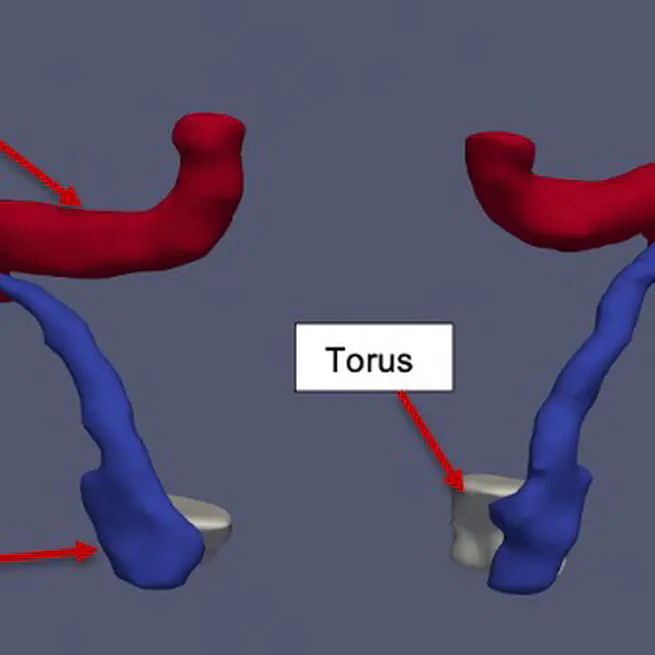 Statistical Shape Model of the Eustachian Tube for Understanding and Managing Eustachian Tube Dysfunction