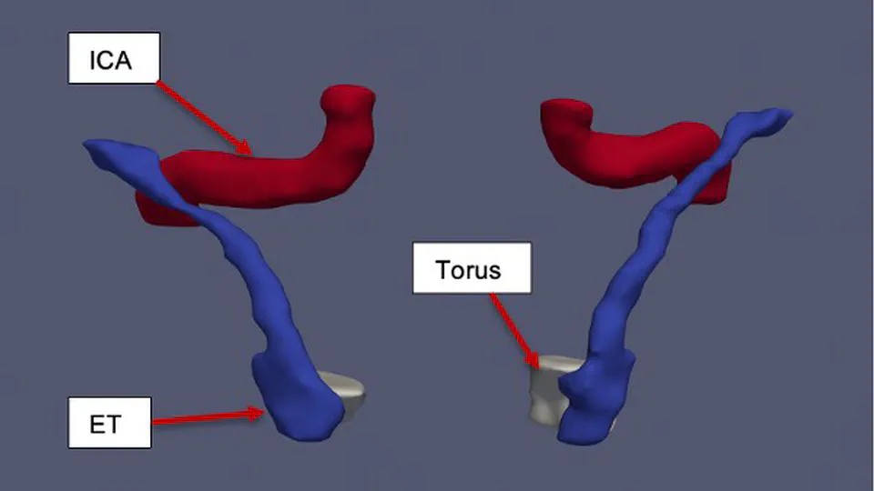Statistical Shape Model of the Eustachian Tube for Understanding and Managing Eustachian Tube Dysfunction
