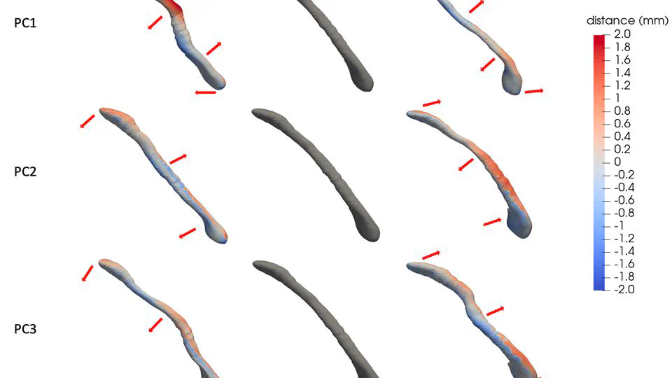 Statistical Shape Model of the Eustachian Tube for Understanding and Managing Eustachian Tube Dysfunction