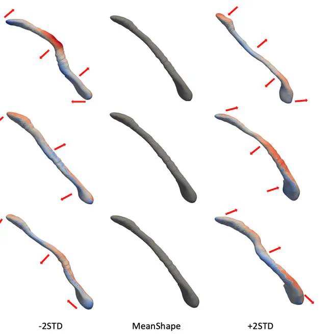 Statistical Shape Model of the Eustachian Tube for Understanding and Managing Eustachian Tube Dysfunction